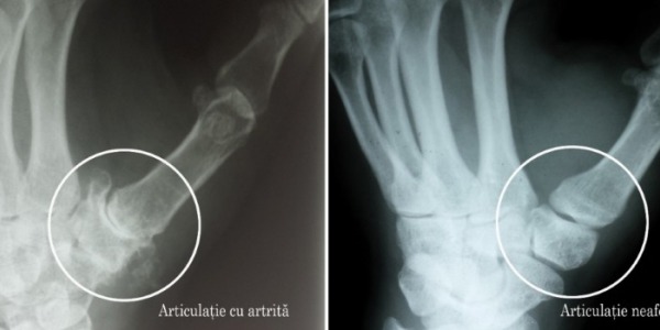 Ce trebuie sa stii despre artrita degenerativa a articulatiilor mainii