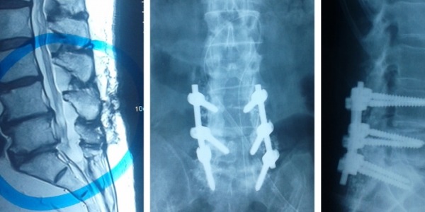 Interventia de fuziune spinala: o sansa pentru cei ce sufera de durere de spate cronica