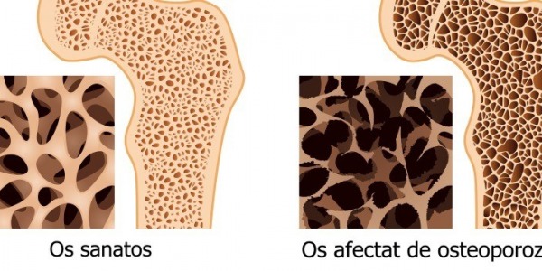Remedii naturale pentru osteoporoza