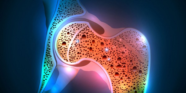 Cum poti preveni complicatiile osteoporozei articulatiei soldului